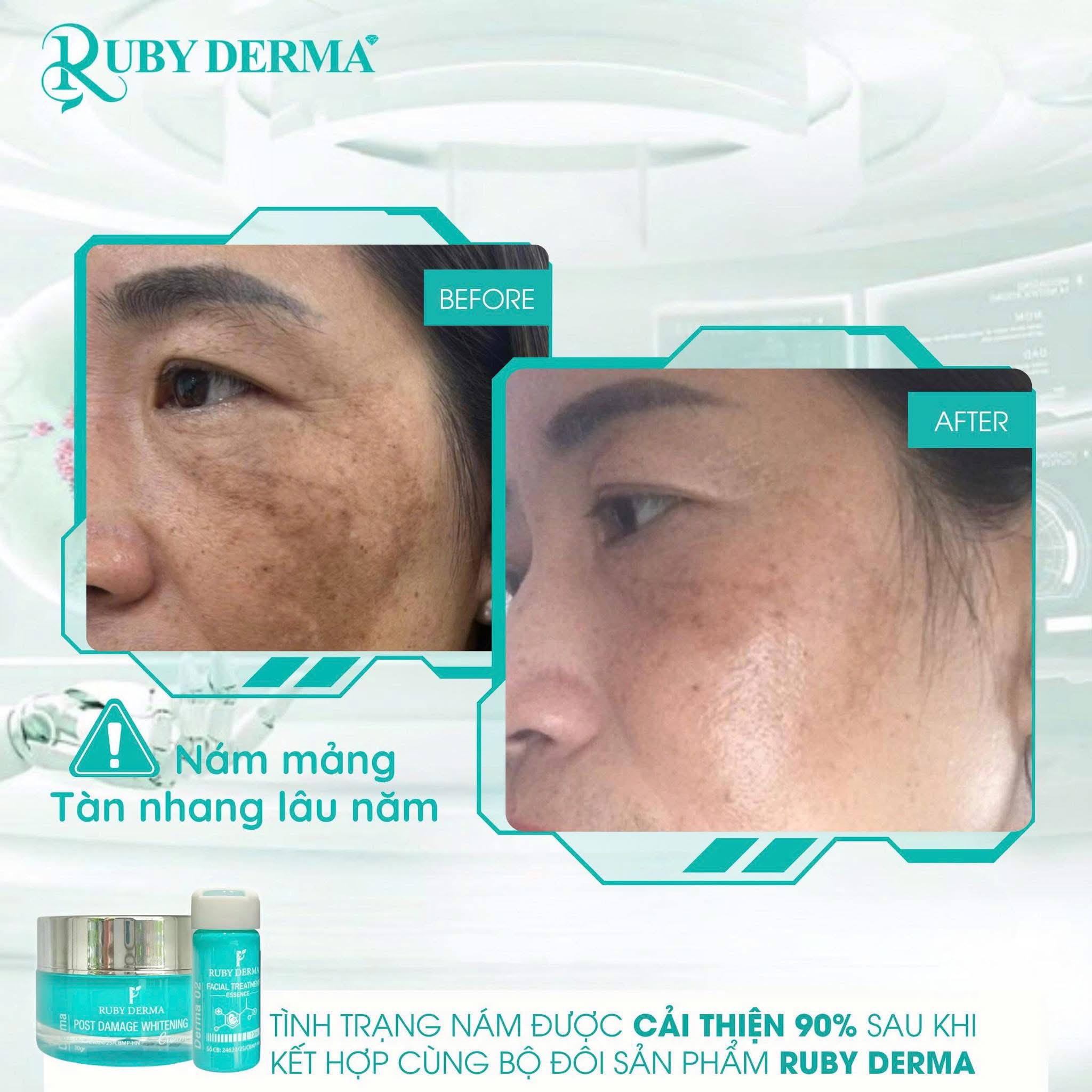 Làn da trắng sáng sạch nám sau khi dùng kem DNA Hồng Yến