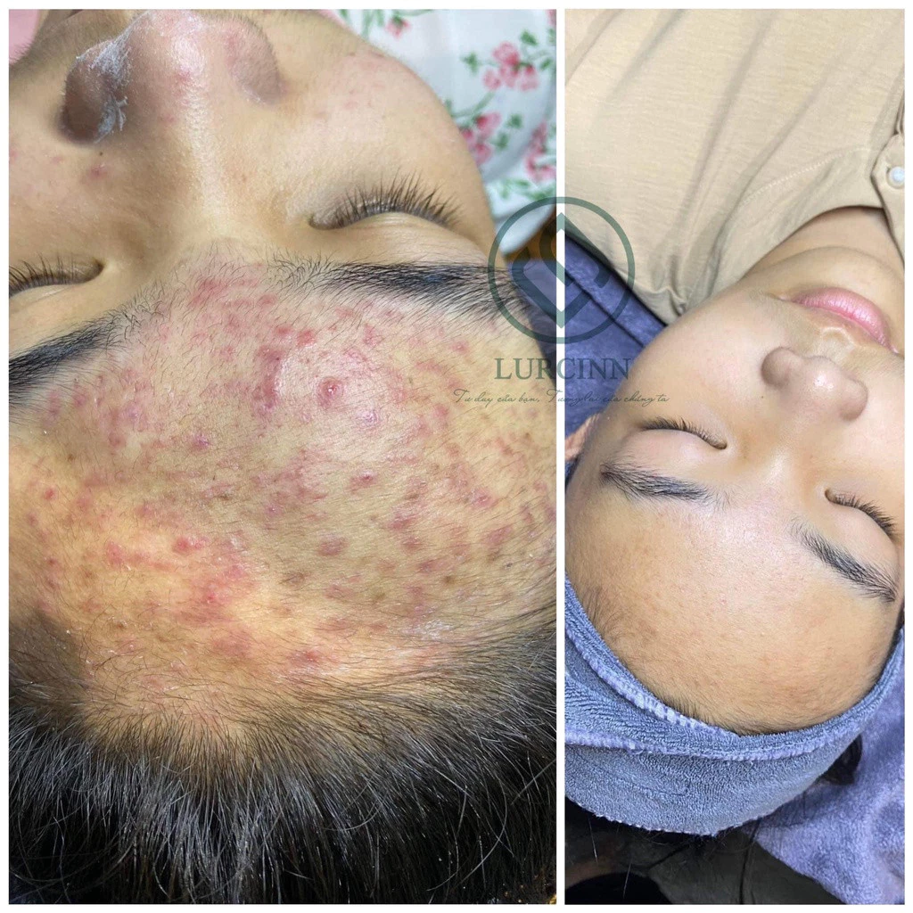 Hiệu quả gom cồi mụn và giảm nhờn của Serum AC Detox